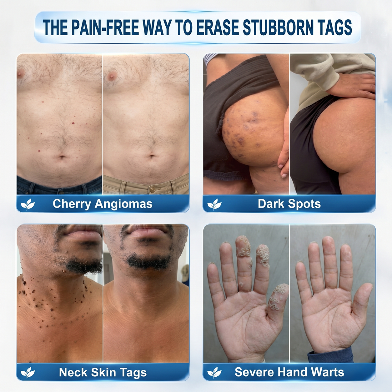 ⭐FDA Registered Facility | Tiworld® 7-Day Skin Tag & Spot Eraser Painless & Scar-Free Advanced Imperfection Removal Rollerball Pen