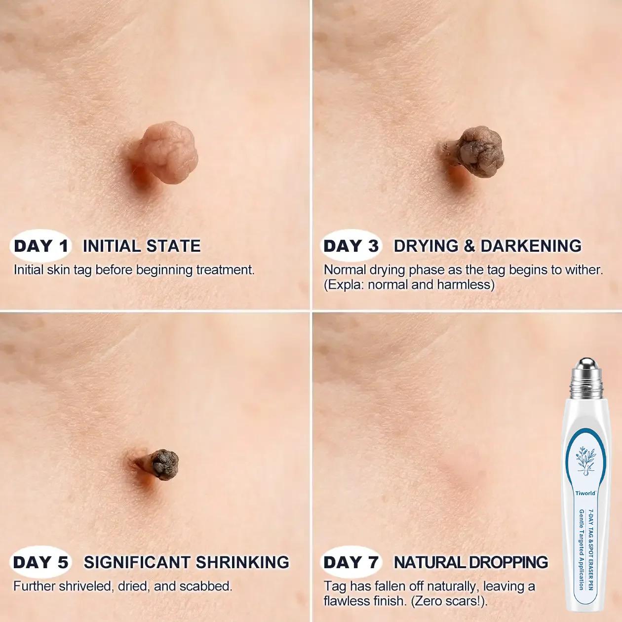 ⭐FDA Registered Facility | Tiworld® 7-Day Skin Tag & Spot Eraser Painless & Scar-Free Advanced Imperfection Removal Rollerball Pen